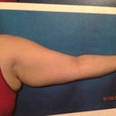 Left arm front pre-op