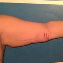 Left arm 1 day after