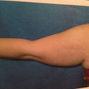 Left arm back side pre-op