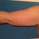 Left arm back view 1 day after