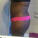 27 days post op left