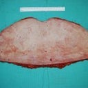 The skin removed during the procedure.  UGH