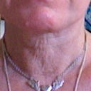 Neck after