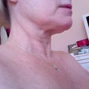 Neck after.