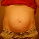 Day before surgery, hernia and all!