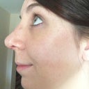 day after cast removal (that is a bruise on the bridge of my nose)