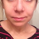 Day after cast removal - the tip is HUGE...so swollen. BUT I can tell the bridge is SO much more narrow under all the swelling.
