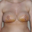 One week post op standing up.