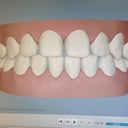 Teeth after