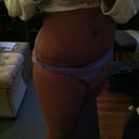 As of today  I'm 7 months! So far so good! Still have a little swelling and numbness!