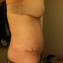 From front- you can see swelling and stretch marks. Cuts around BB are where the tape holding the marble into my BB has damaged my skin. Taking a break from that for now.