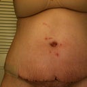 With pants on. 3 Weeks PO.