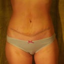 22 day PO. still have some swelling but my waist is fine and my muscles can do without CG now, though I will continue to wear it not to loose my results