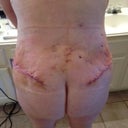Day 6 Back - this has definitely been the sorest part.  I have moved the pads under my CG to cover these parts today and it feels infinitely better.  It's not red, or hot, but I just think I'm leaning on it alot as I sit in the recliner so it aggravates it.