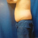 Pre-Surgery
