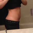 Post op day 18
