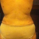 2 months Post lipo