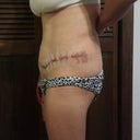 Day three post op
