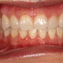 Invisalign