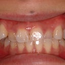 Invisalign