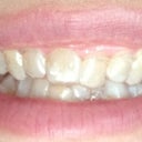 June 2012-  1st upper tray without buttons (you can't see it too well, but my top front tooth will have 2 buttons on it!  Not too happy!)  2nd Tray on bottom teeth with buttons.