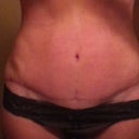 7 wks incision