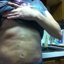 2 weeks post op