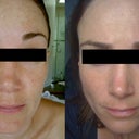 Left shot: take FEB 13, 2011, Right shot: Taken APRIL 18, 2011.
8 treatments and 2 months in between photos.