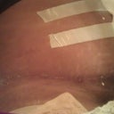 Scar healing nicely at 3 weeks PO. Dr. Robles did the darn thang! My scar is very thin and very low!!! Excellent!!