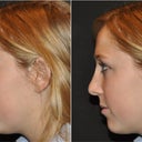 My current profile vs. the morphed profile.  Obviously my new nose won't look exactly like this, but it's a start.