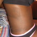 AFTER, me sitting down, no more mini roll, (the dark lines are from the dark blue marker he used to mark the areas prior to the procedure - I never bruised this time nor the 1st time)