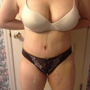 Lots of swelling because it was the end of the day. 9 days postop. Belly button off center??