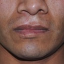 32 Year Old Male Treated For A Cleft Lip