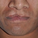 32 Year Old Male Treated For A Cleft Lip