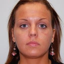 HA Filler Under The Eyes/ Teartrough