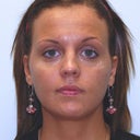 HA Filler Under The Eyes/ Teartrough