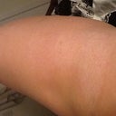 Scar after following the PS advice.