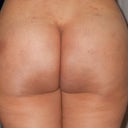 3 weeks post op 2