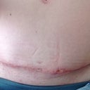 5 weeks. Open area above groin that is really bothering me.