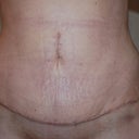 4 weeks post-op