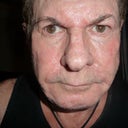 After 90 days. no lifting skin, no lifting hooded eyes.