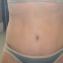 4 Weeks post-op.  Still have some swelling and belly button redness, but I think it's looking pretty good.  Look how low the bikini is. WOO HOO!!!!