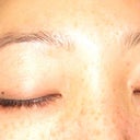 12 weeks later. Also just began using the generic version - Lumigan!