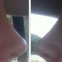 6 Weeks Post Surgery