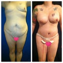 Side by side 1 wk PO