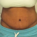 15 day PO, first time seeing my scar