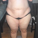 Before tummy tuck and lipo