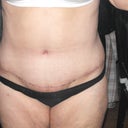 After - 2 weeks post-op tummy tuck and lipo