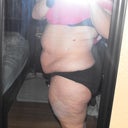 Before tummy tuck and lipo
