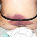 Lipo bruising - 5 days post-op